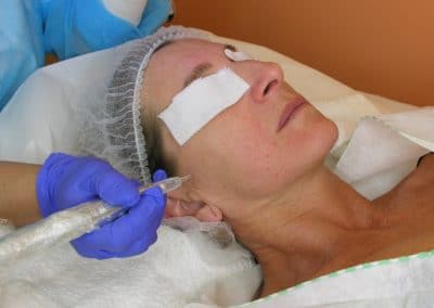 Microneedling Durante