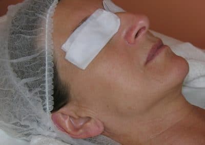 Microneedling Prima